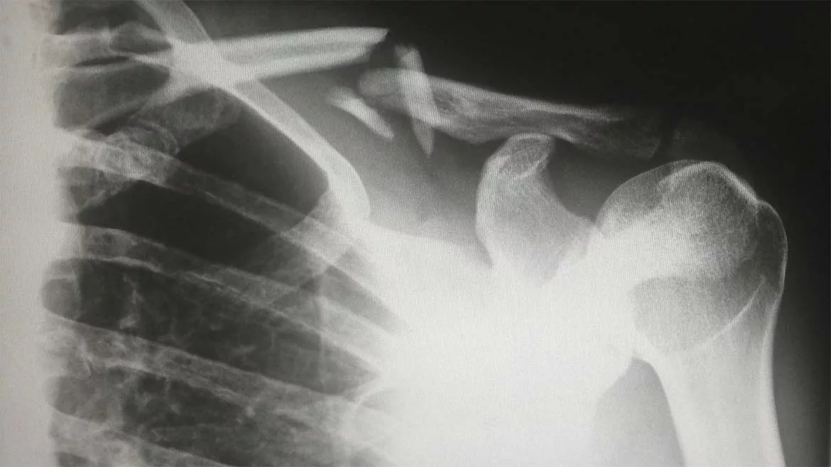 X-Ray